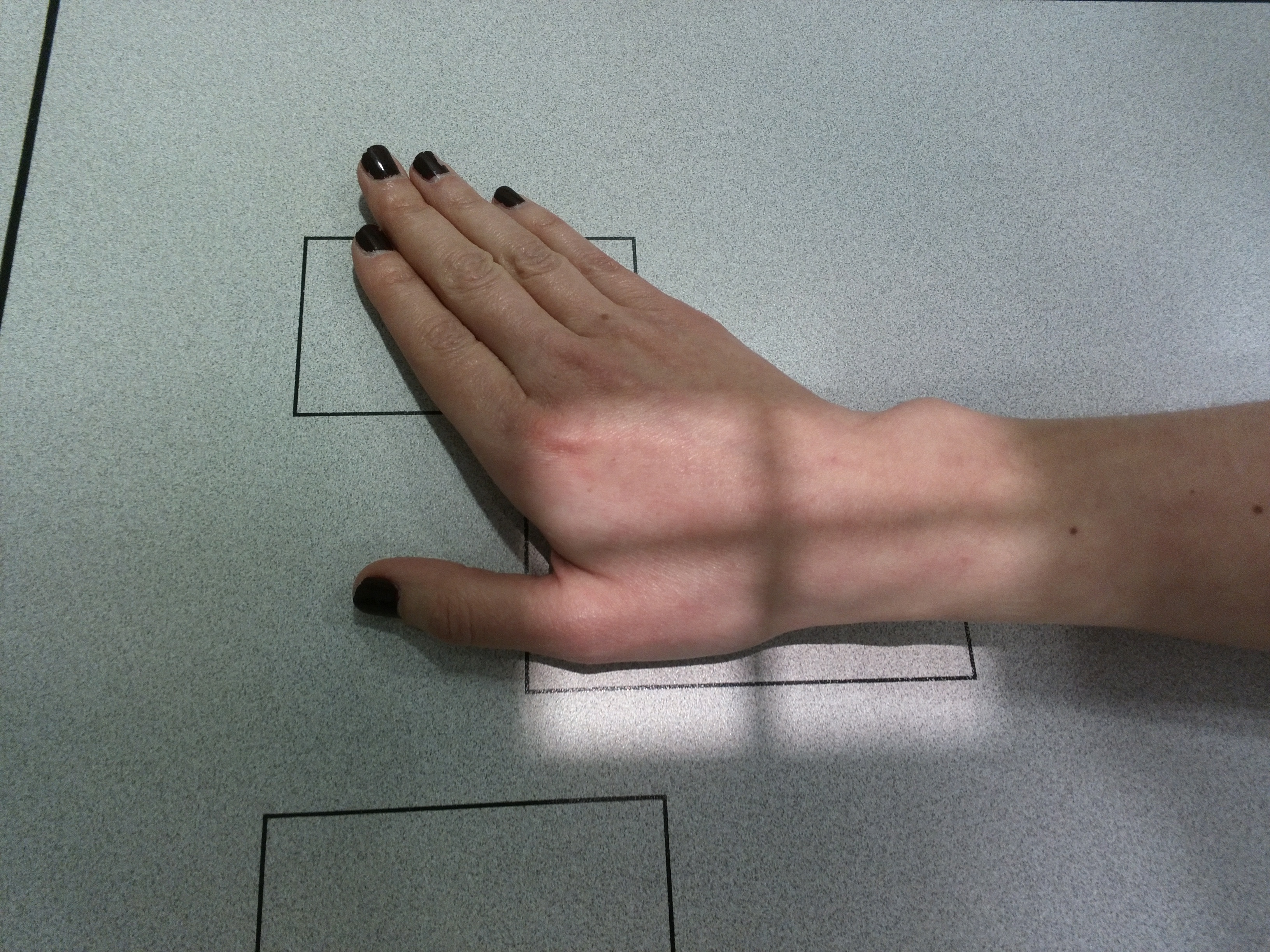 Radiografía PA Escafoides